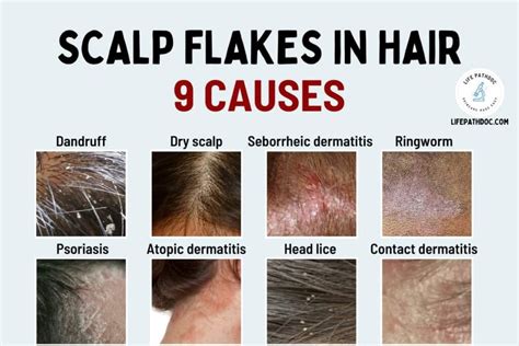 how to get rid of dandruff stuck on scalp Scalp flakes in hair ...