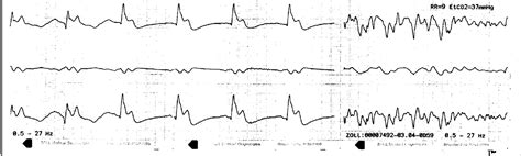 Dr. Smith's ECG Blog: 30 Year Old with Cardiac Arrest, PEA, then Cardiac Ultrasound