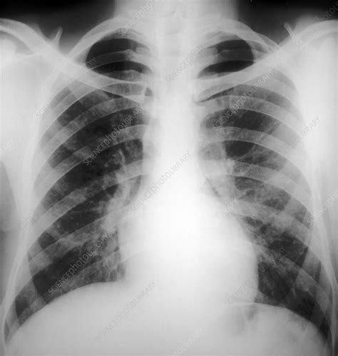 Bronchiolitis Chest X Ray