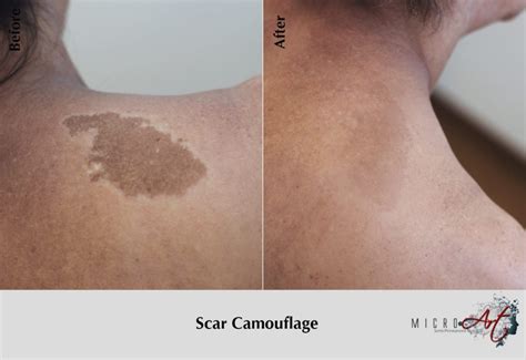 Scar Treatment By MicroArt Semi Permanent Scar Camouflage