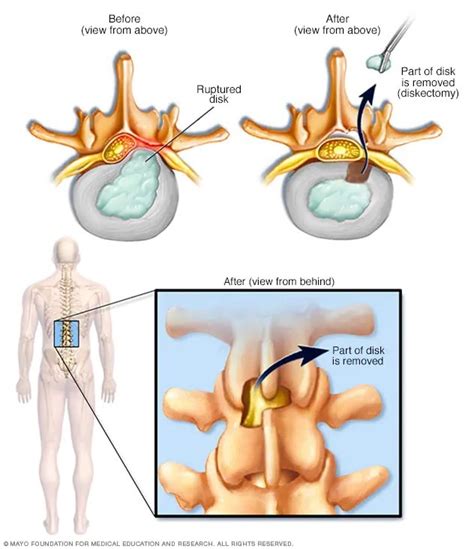 Herniated disk - Diagnosis and treatment (2022)