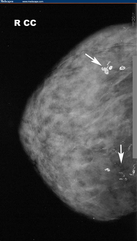 Breast Calcifications - Sex Nurse Local