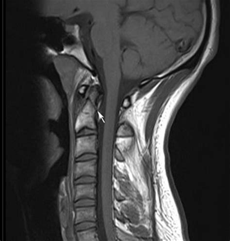 Odontoid Fracture Treatment