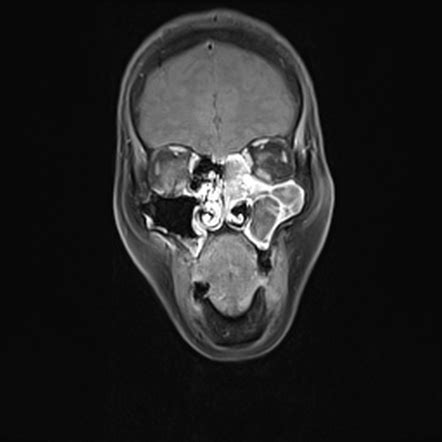 Inverted papilloma | Image | Radiopaedia.org