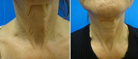 Patient 38566946 | Laser Skin Tightening Before & After Photos ...