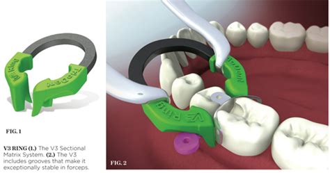 V3 Sectional Matrix System - Triodent | Nov/Dec 2009 | Inside Dentistry