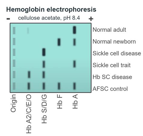 Hemoglobin electrophoresis - Wikiwand