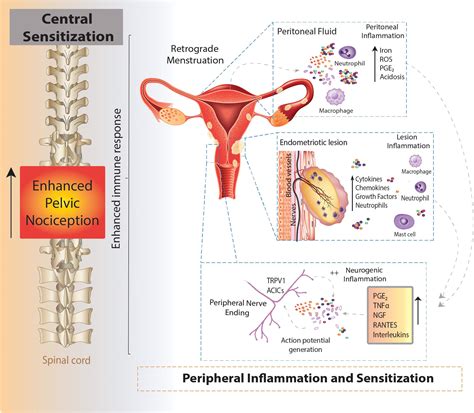 Endometriosis Pain