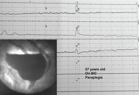 Neurogenic Bladder Obstruction | Abdominal Key