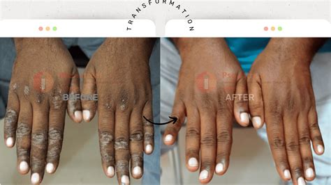 Successful Palmoplantar Psoriasis Treatment: A Homeopathic Case Study - Psoriasis Treatment ...