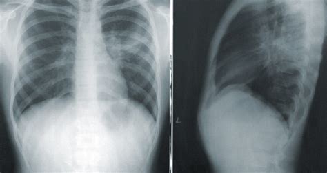 PleurX Drainage Catheter: What to Expect From Your PleurX Placement Procedure? - Health Thoroughfare