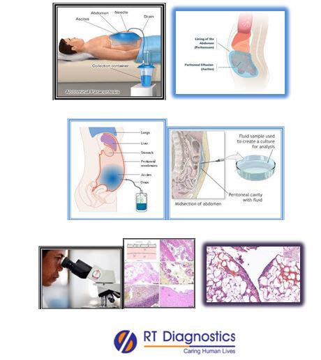 Cytology - Peritoneal Fluid | RT Diagnostics