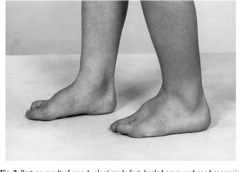 Figure 2 from Congenital cleft foot deformity. | Semantic Scholar