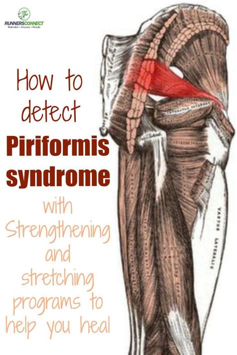 Piriformis Syndrome Trigger Points