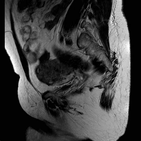 Uterine adenomyosis treated by transcatheter uterine artery ...