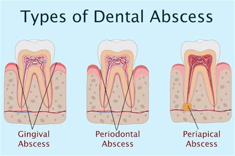 types of tooth abscess | Tooth infection, Periodontitis, Tooth ...