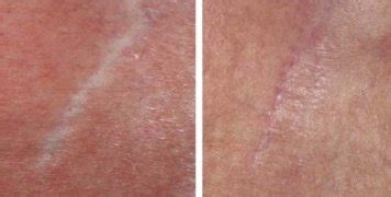 Derma Roller Before & After Pictures|Acne Scars, Stretch marks etc