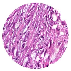 4 Types of Mesothelioma | Cell Location, Cell Type and Treatment