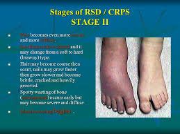 Internal organs affected by CRPS. New research accepts this.