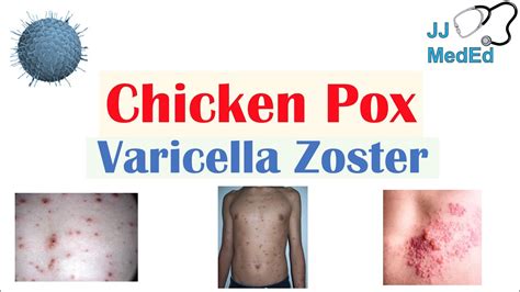 Chicken Pox Pictures In Adults