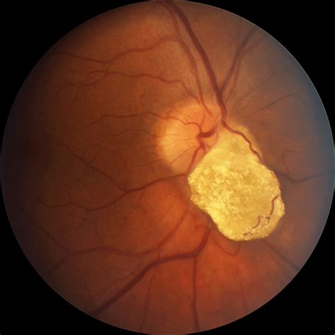 1000+ images about Ophthalmology on Pinterest