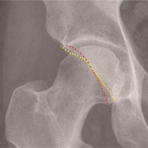 Acetabular index. A line is drawn between the points that represent the... | Download Scientific ...