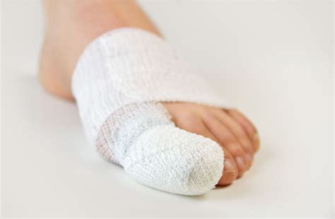 What Is the Recovery Time for Hallux Rigidus Surgery?