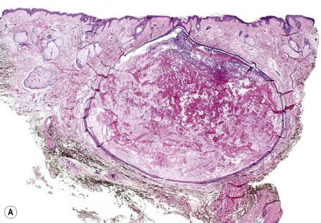 Cutaneous cysts | Basicmedical Key