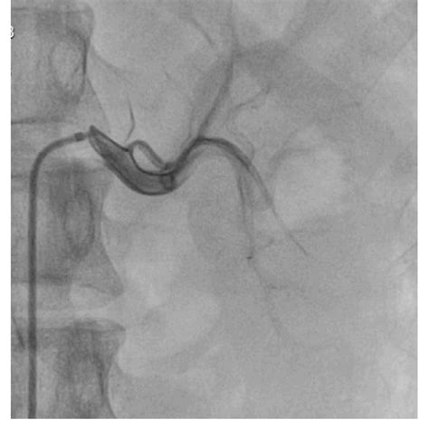 Left renal angiogram. | Download Scientific Diagram