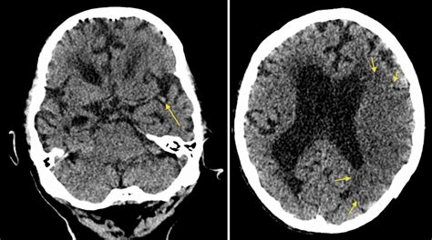 Acute MCA infarct - dot sign - Radiology at St. Vincent's University ...