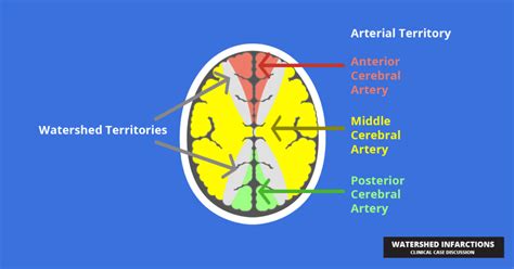 Watershed Infarctions - Clinical Case Discussion - Tiny Medicine