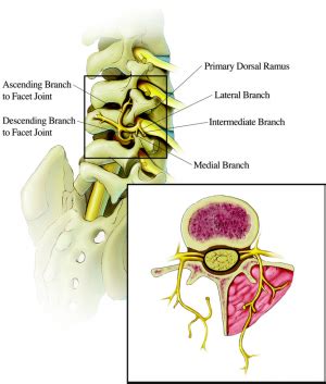 Lumbar Facet Syndrome - Physiopedia