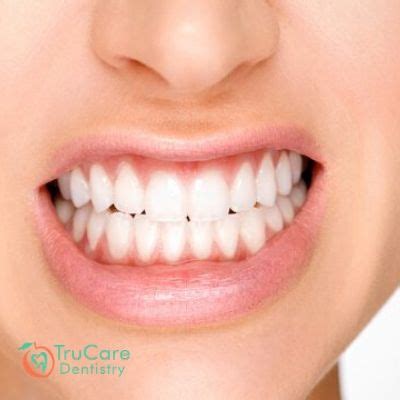 Ways You Can Stop Grinding Teeth During Sleep – TruCare Dentistry