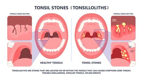 77 Adenoid Tonsil Removal Images, Stock Photos, 3D objects, & Vectors | Shutterstock