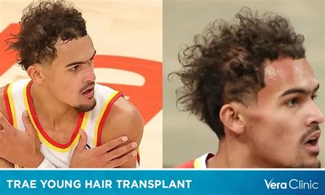 Trae Young Hair Transplant: Addressing Hair Transformation