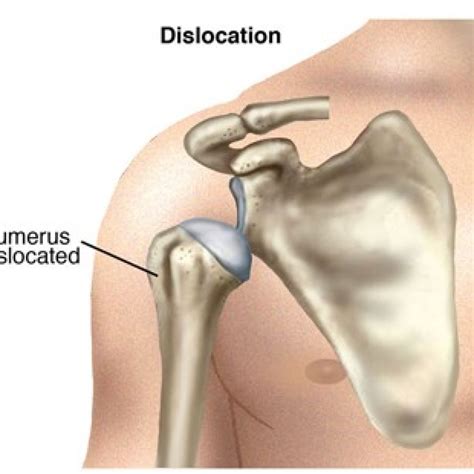 Archview Physiotherapy Clinic | Physiotherapist | Dislocated shoulder | Archview Physiotherapy ...