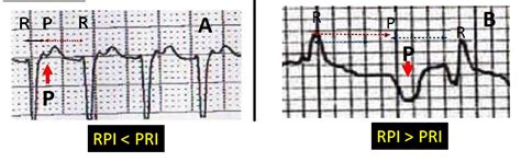 ECG Channel: Supraventricular Tachycardia