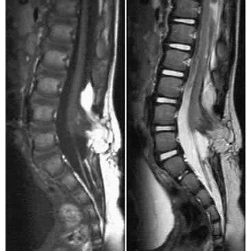 (PDF) Spinal Rhabdomyosarcoma in a Child with Lipomyelomeningocele