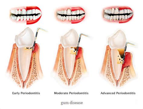 Periodontics (Gum Treatment) | Coden Specialists
