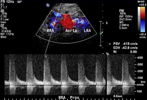 Renal artery ultrasound protocol