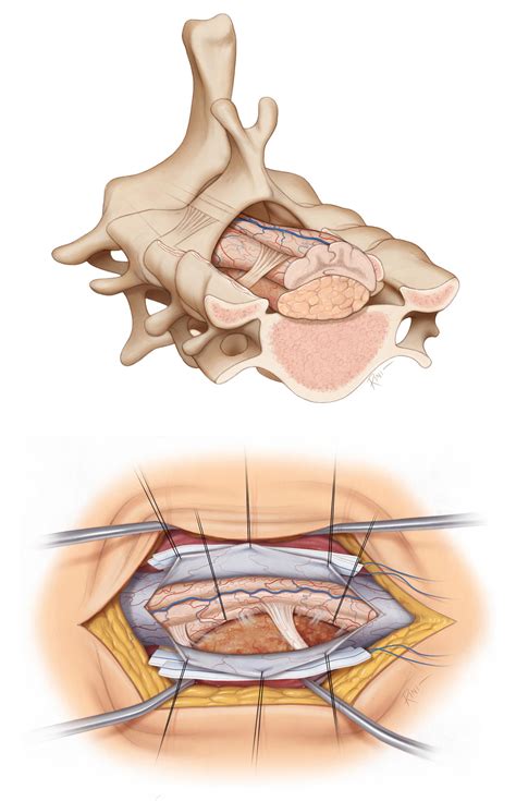 Extramedullary Spinal Cord Tumor | The Neurosurgical Atlas, by Aaron Cohen-Gadol, M.D.