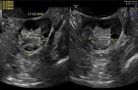 Ovarian Cysts