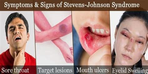 Stevens-Johnson Syndrome (Symptoms, Diagnosis, Treatment, and Prevention) - Assignment Point