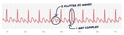 What Atrial Flutter Looks Like on Your Watch ECG | Qaly