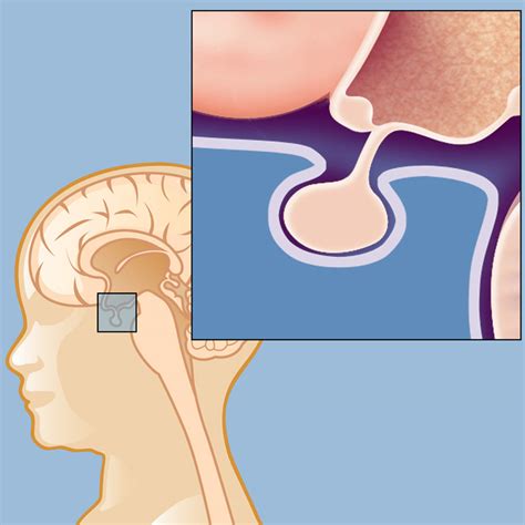 Craniopharyngiomas | Weill Cornell Brain and Spine Center