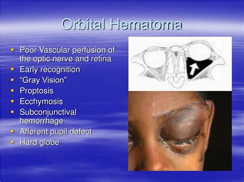 PPT - Orbital Floor Fractures PowerPoint Presentation - ID:26543