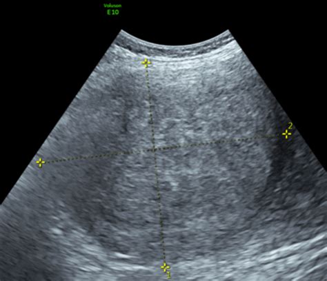 Dermoid Cyst Ovary Eye