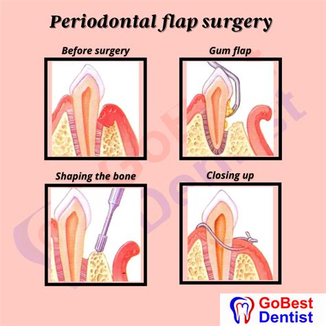 Flap Surgery & Gum Treatments - Gobest Dentist