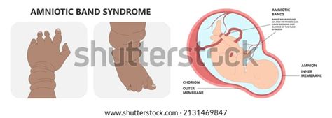 48 Maffucci Syndrome Images, Stock Photos, 3D objects, & Vectors | Shutterstock