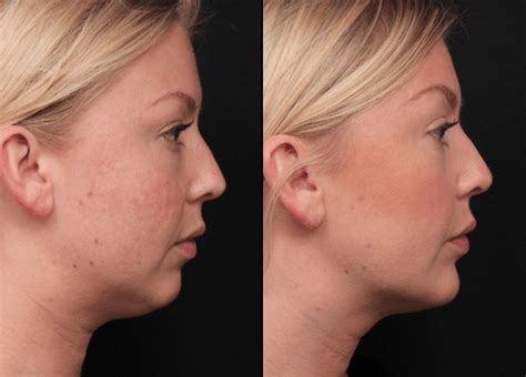 Double Chin Non Surgical Removal & Reduction | Shape Clinic